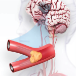 4- American Stroke Association